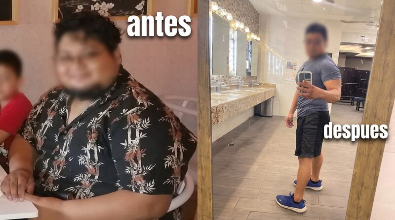 Before and after bariatric surgery — Case 1