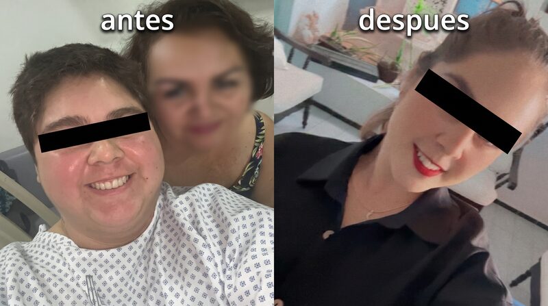 Before and after bariatric surgery — Case 2