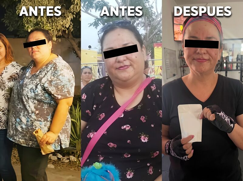 Before and after bariatric surgery — Case 3