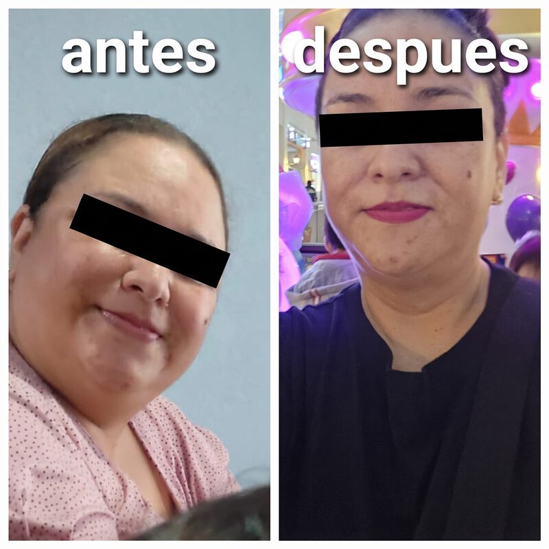 Before and after bariatric surgery — Case 4